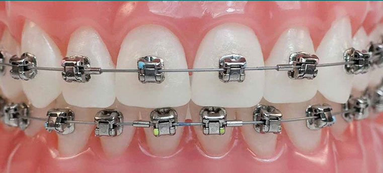 FIM DO TRATAMENTO ORTODONTICO: LIMPEZA DOS DENTES E CLAREAMENTO DENTAL SÃO  INDICADOS NESSA FASE – Achei Odontologia