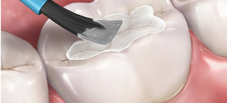 Selantes de dentes