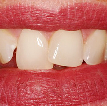Dentes da frente tortos