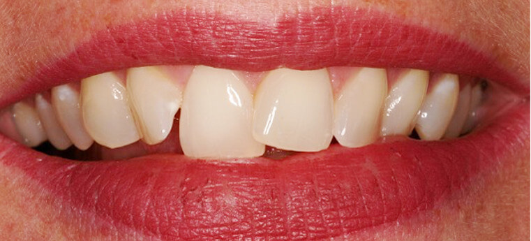 Featured image of post Dente Encavalado Antes E Depois No me despert antes de las 8