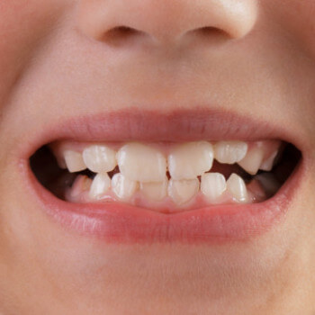 Todos os dentes de leite caem?