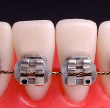 Posso colocar aparelho apenas nos dentes de baixo