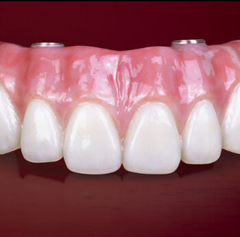 Dentes de Porcelana pata Prótese Total