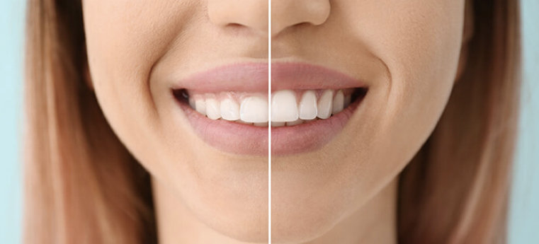 Gengivoplastia em Campo Grande RJ e na Barra da Tijuca